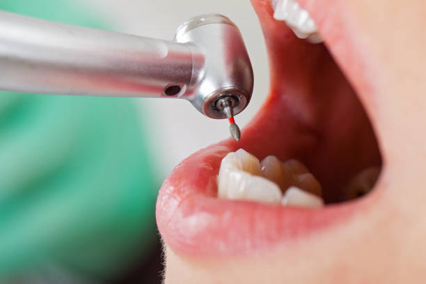 Best Lost Filling or Crown Replacement in Somerset, PA